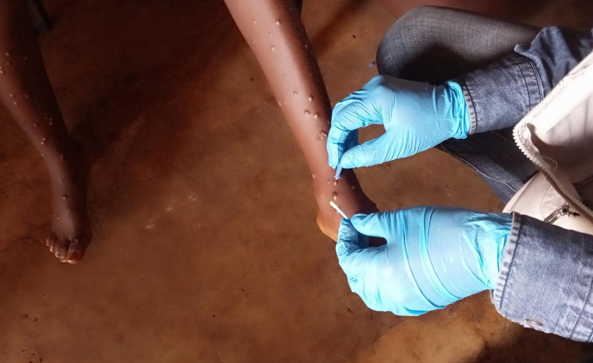 Africa: Rwanda Gets a Grip Of Marburg, But Mpox ‘Not Yet Under Control’